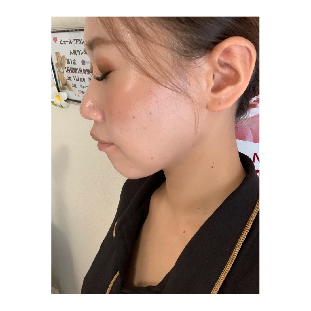 東西線西葛西駅より徒歩2分のところにある脱毛サロンpur Blanc ピュールブラン フォトフェイシャルの効果