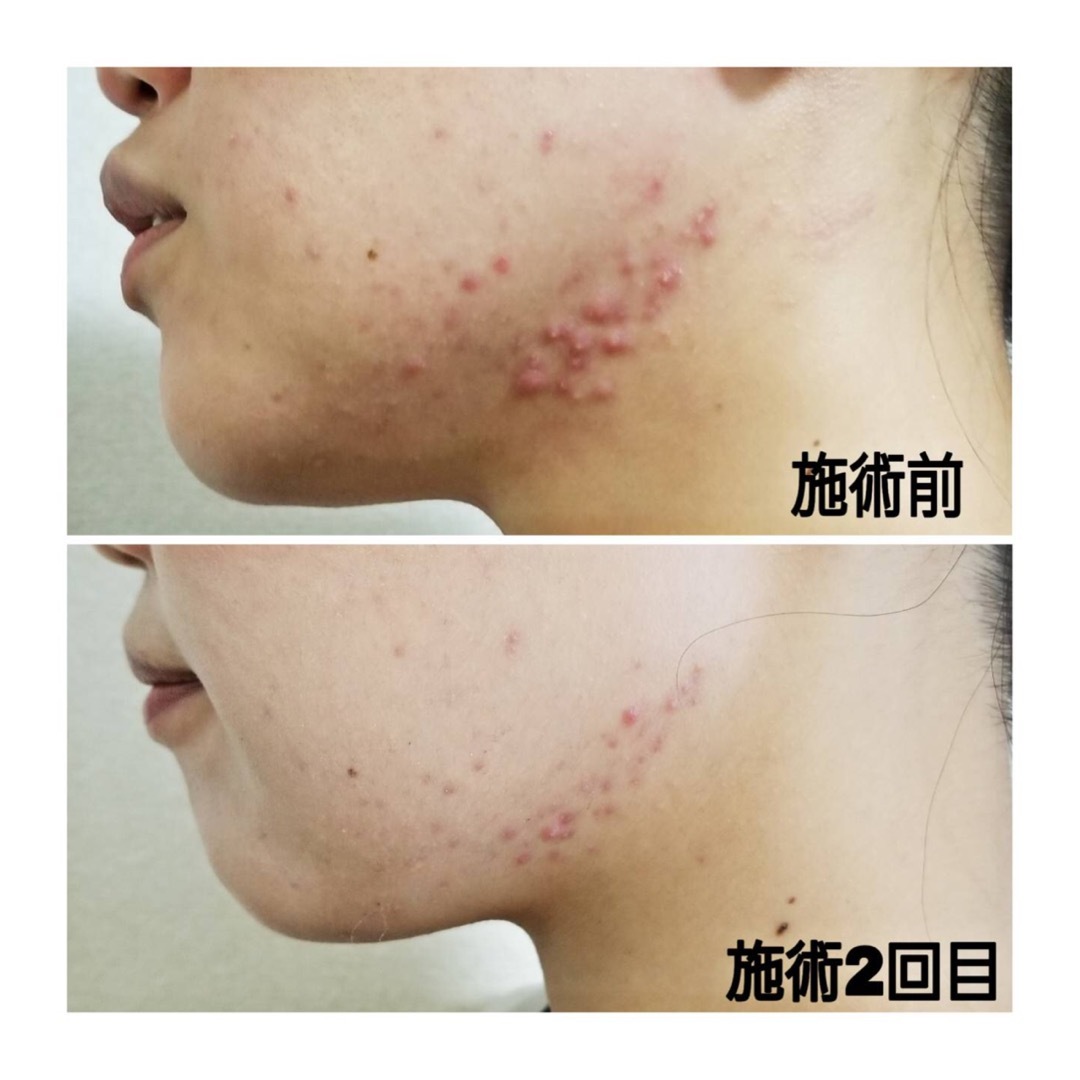 東西線西葛西駅より徒歩2分のところにある脱毛サロンpur Blanc ピュールブラン フォトフェイシャルの効果